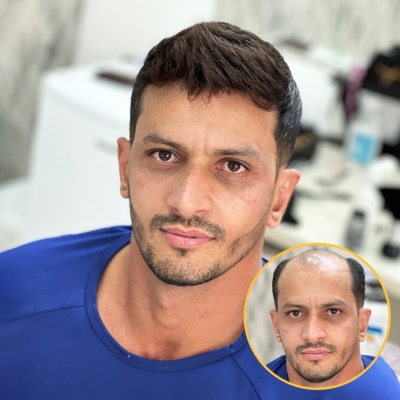 AvenHair Flex Lace Hair System with PU Back and Sides