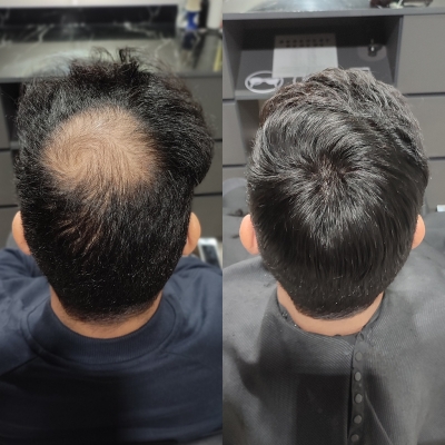 AvenHair French Lace Hair System with Natural Hairline