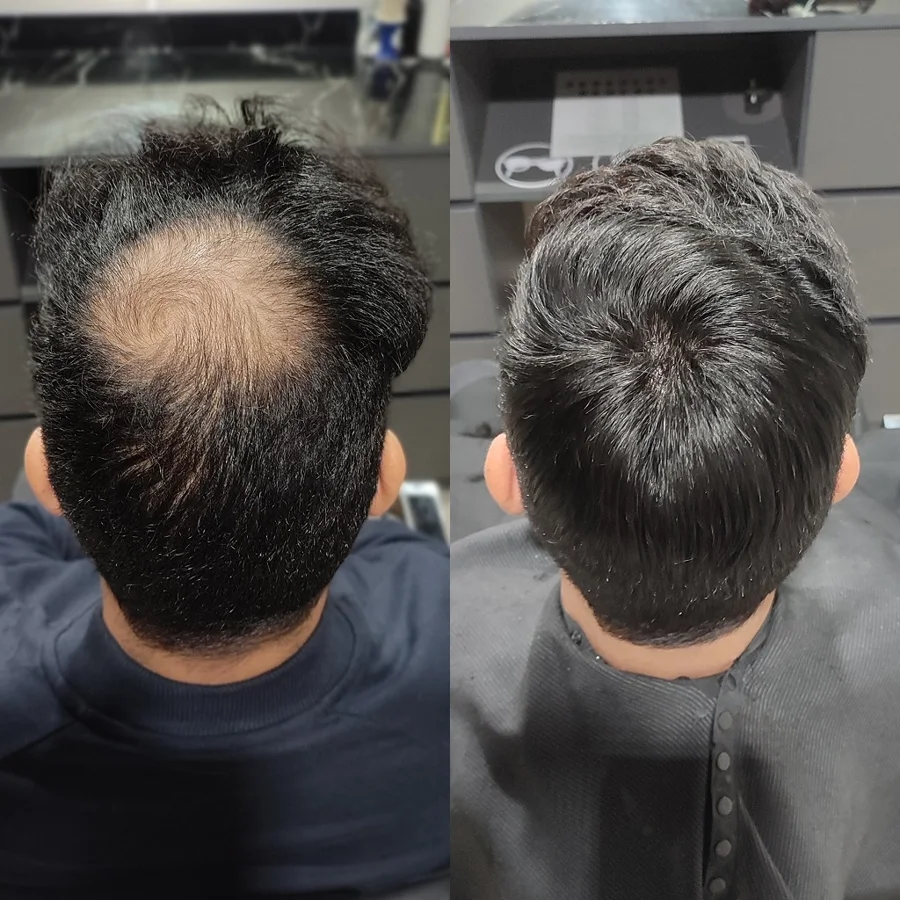 Before and after: thinning crown covered with a hair system, seen from above
