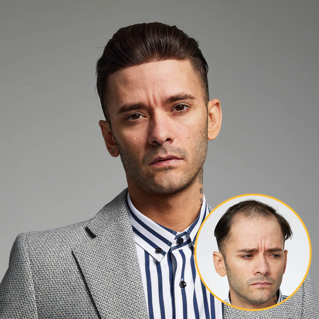 AvenHair 0.08-0.10mm Thin Skin Hair System, 130% Density