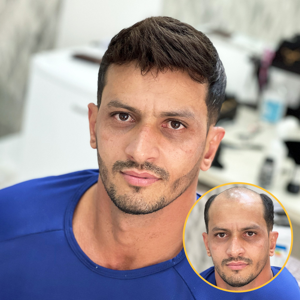 AvenHair Flex Lace Hair System with PU Back and Sides