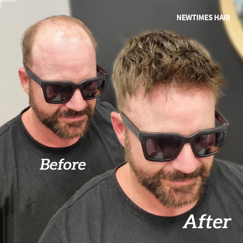 AvenHair 0.08mm Injected Thin Skin Hair System for Men
